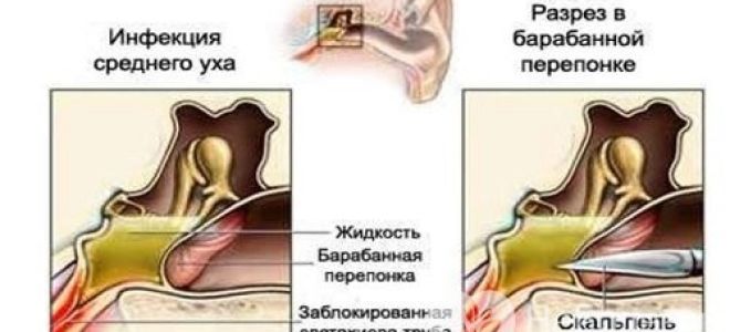 Отит у ребенка — симптомы и методы лечения заболевания детей