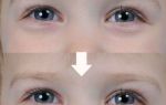 Синяки под глазами у ребенка — причина появления у малыша