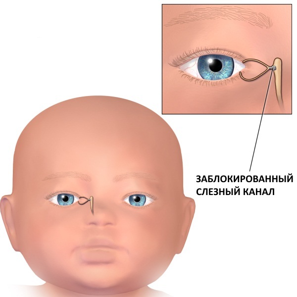 Закупорка (непроходимость) слезного канала у новорожденных