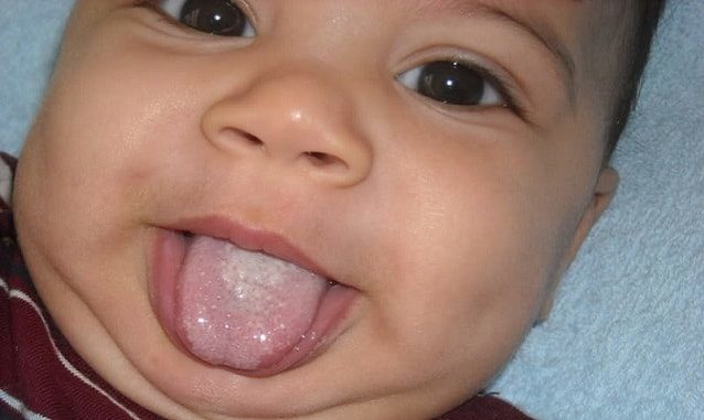 Молочница у новорожденных во рту – симптомы, лечение и профилактика