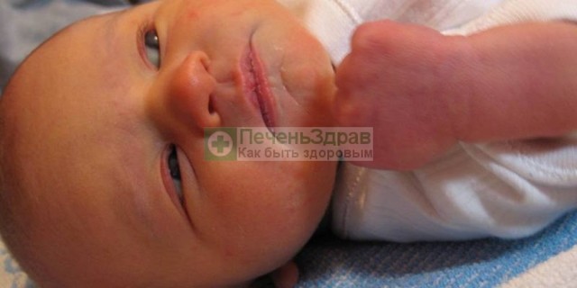 Физиологическая желтуха у новорожденных, виды и причины возникновения