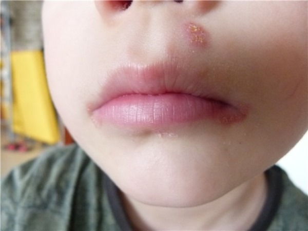 У ребенка герпес на губе: чем лечить