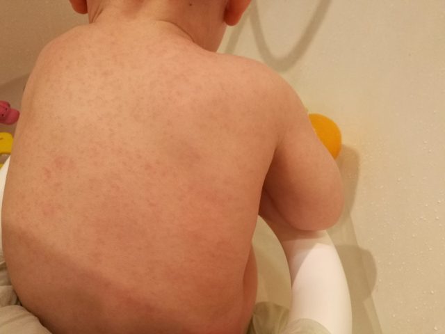 Сыпь на животе и спине у ребенка: без температуры: причины