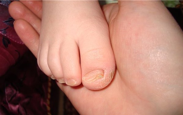 Гибок на ногах у ребенка: лечение