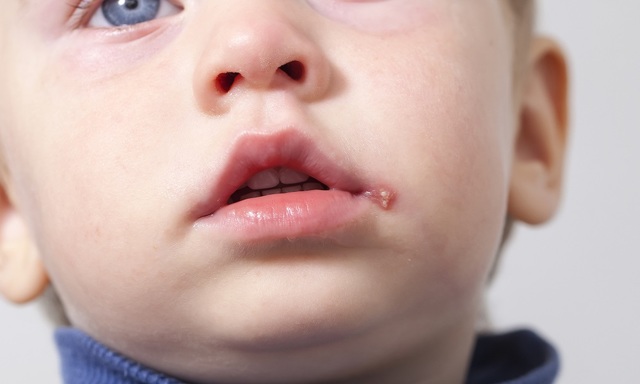 У ребенка герпес на губе: чем лечить