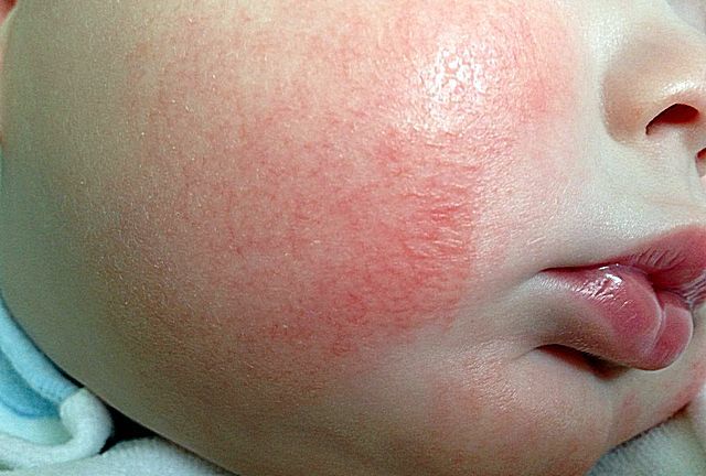 Чем лечить диатез на щеках у ребенка