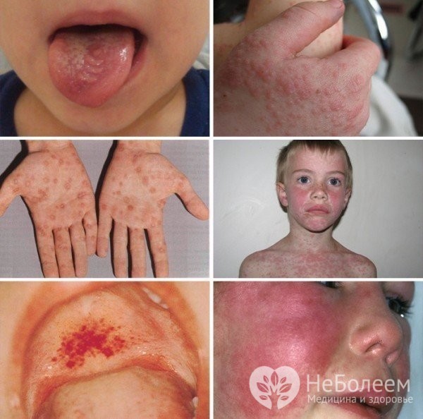 Инфекционный мононуклеоз у детей - лечение и профилактика