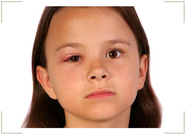 Ячмень на глазу у ребенка: симптомы, причины и лечение