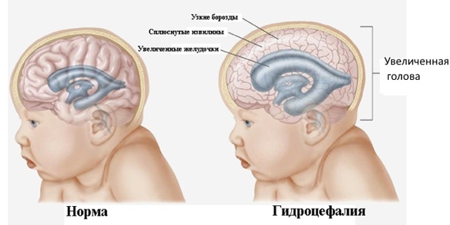 Окружность головы ребенка по месяцам - таблица