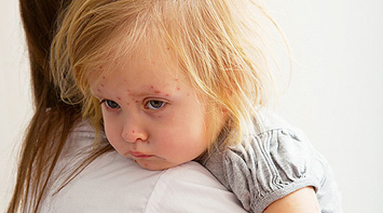 Корь у детей симптомы: лечение