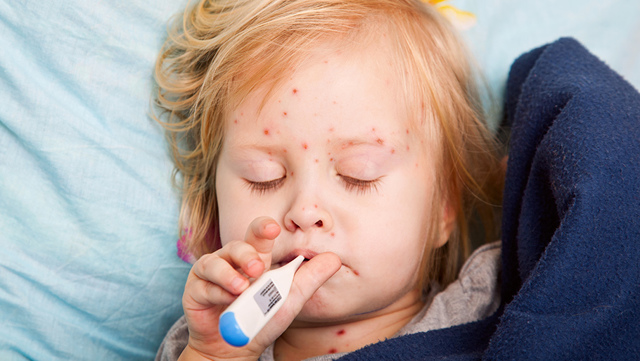 Симптомы краснухи у ребенка и методы ее лечения