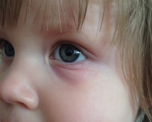 Синяки под глазами у ребенка - причина появления у малыша