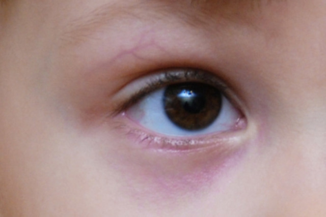 Синяки под глазами у ребенка - причина появления у малыша