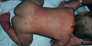 Лечим пеленочный дерматит у новорожденных