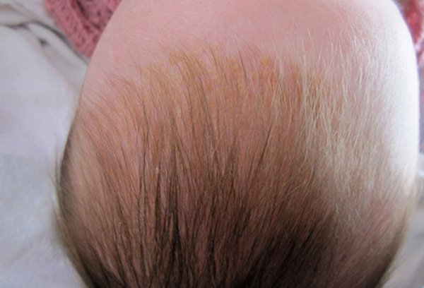 У ребенка шелушится кожа на голове: Причины
