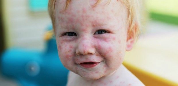 Симптомы краснухи у ребенка и методы ее лечения