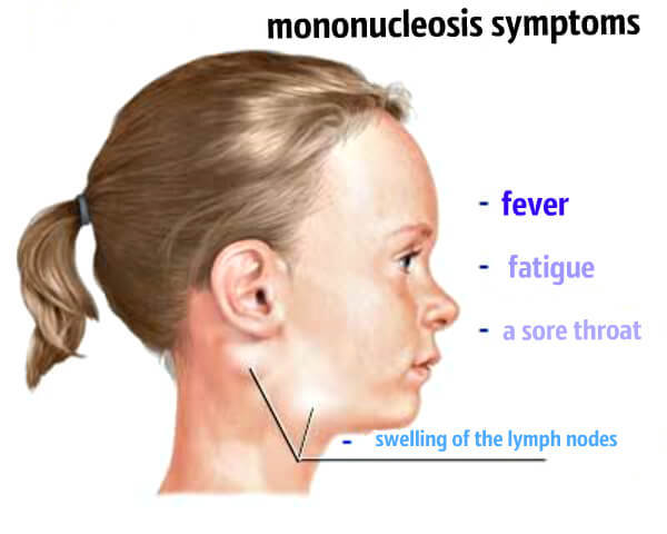 Мононуклеоз у детей: Лечение, Симптомы