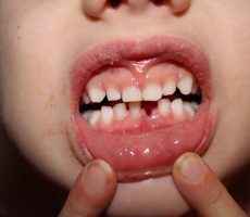 Когда меняются молочные зубы у детей