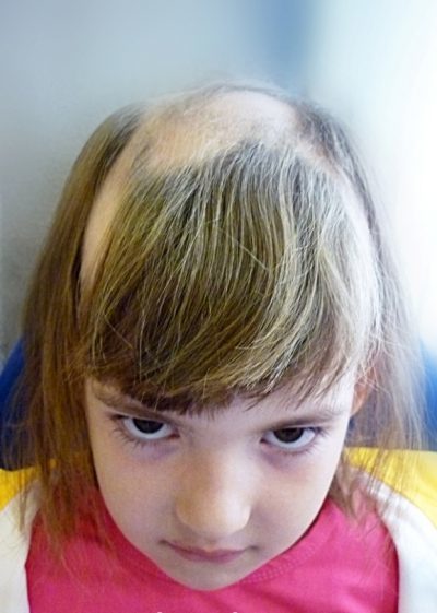 У ребенка выпадают волосы: что делать
