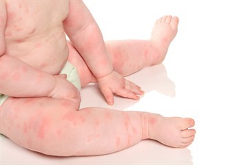 Как разводить смекту для ребенка при поносе, аллергии