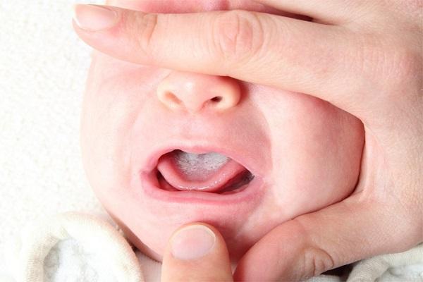 Молочница у новорожденных во рту – симптомы, лечение и профилактика