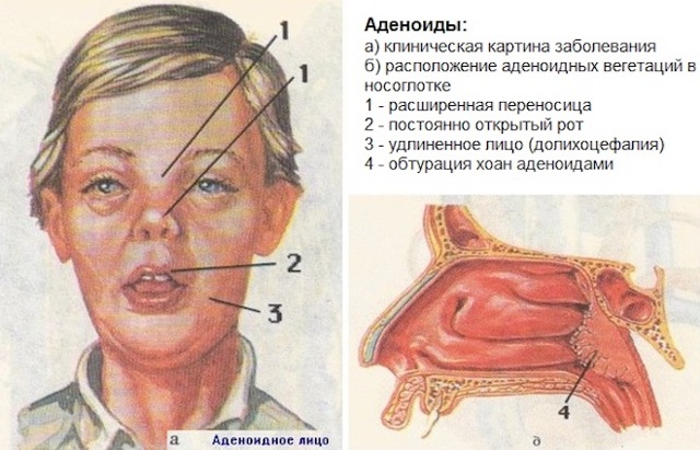 Аденоиды у детей - симптомы, признаки, лечение