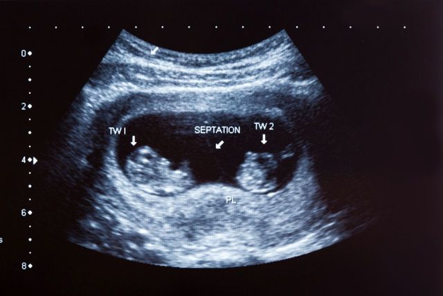 Признаки двойни на ранних сроках беременности