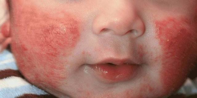 Чем лечить диатез на щеках у ребенка