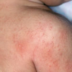 Сыпь на животе и спине у ребенка: без температуры: причины
