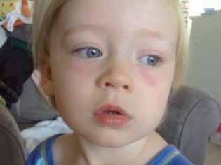 Причины синяков под глазами у ребенка, появление и лечение их у грудничков